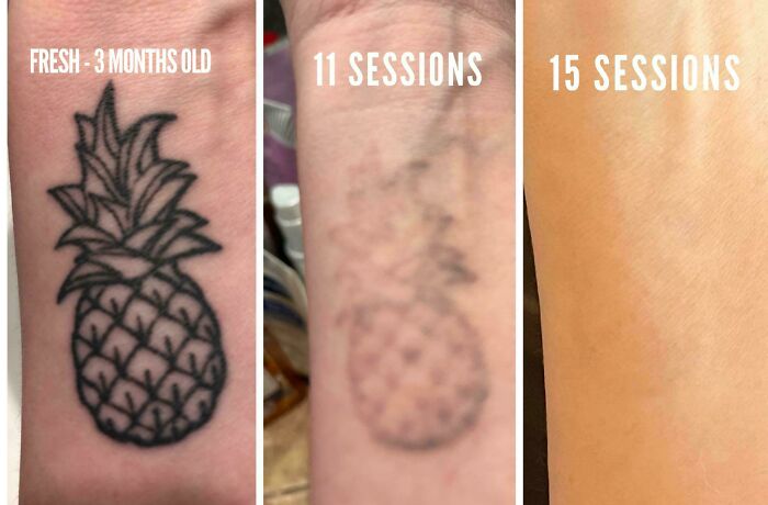 “Changed My Life!” 80 Photos Before And After Tattoo Removal