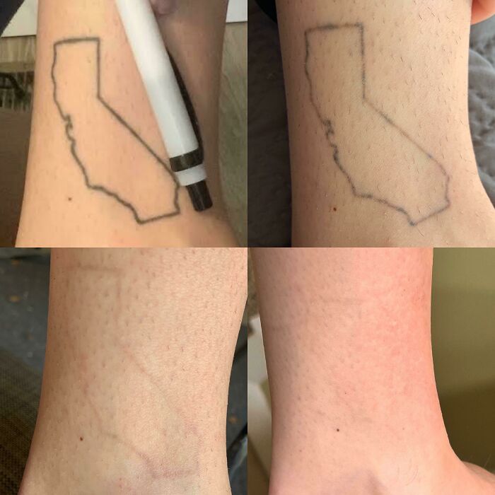 “Changed My Life!” 80 Photos Before And After Tattoo Removal