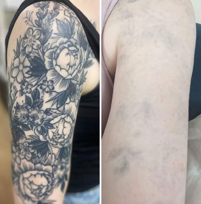 “Changed My Life!” 80 Photos Before And After Tattoo Removal