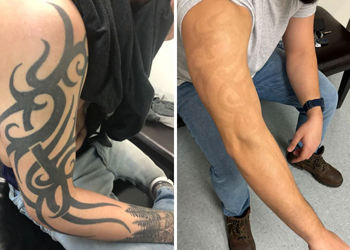 “Changed My Life!” 80 Photos Before And After Tattoo Removal