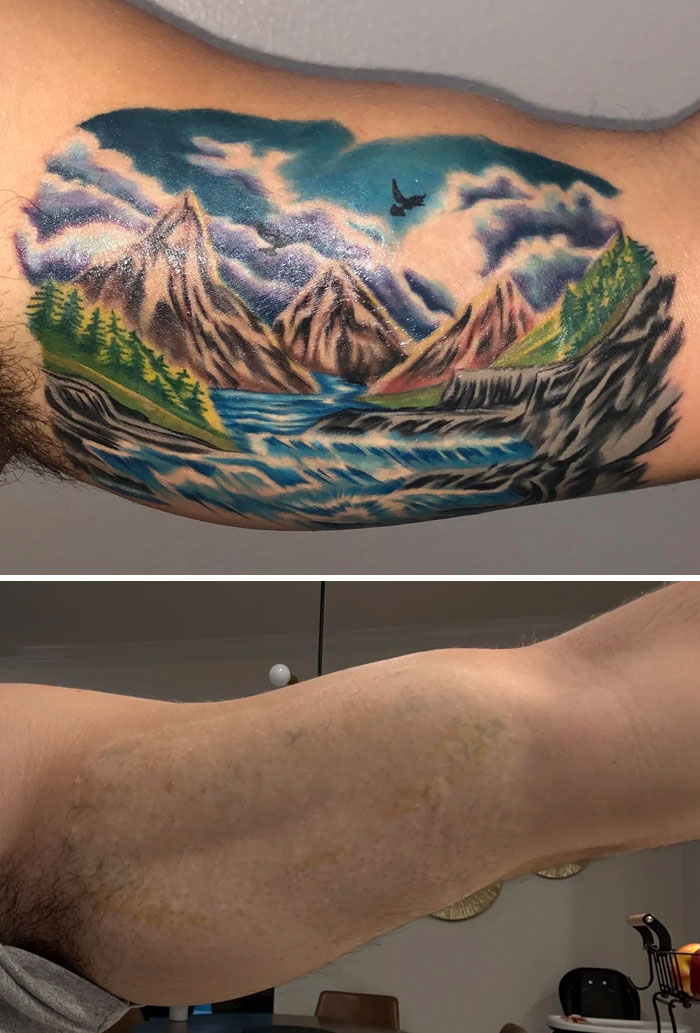 “Changed My Life!” 80 Photos Before And After Tattoo Removal