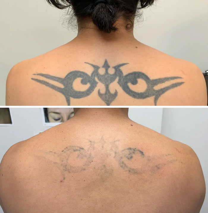 “Changed My Life!” 80 Photos Before And After Tattoo Removal