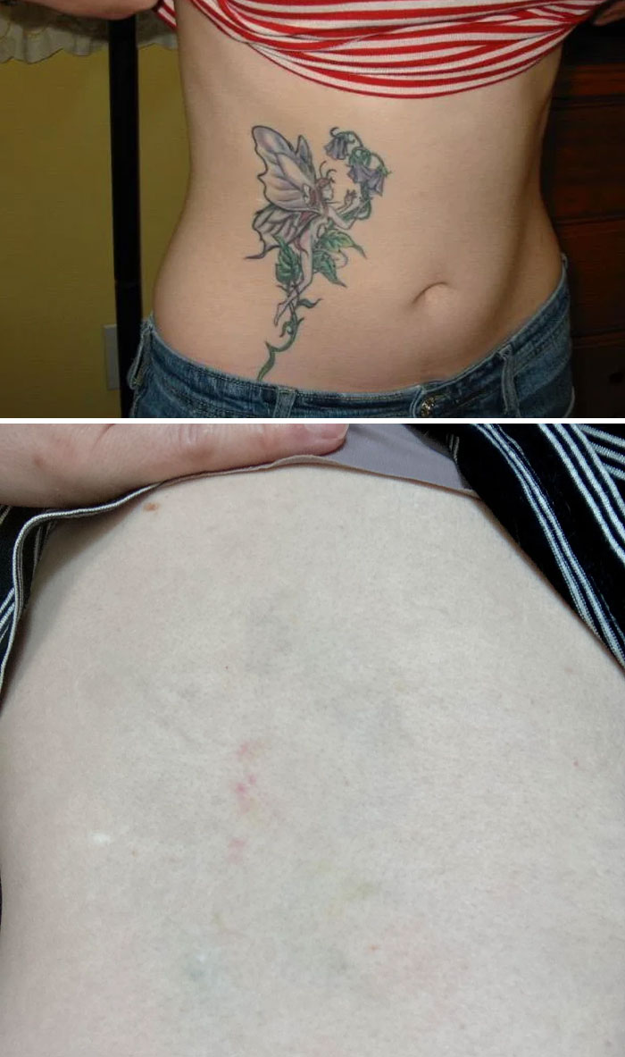 “Changed My Life!” 80 Photos Before And After Tattoo Removal