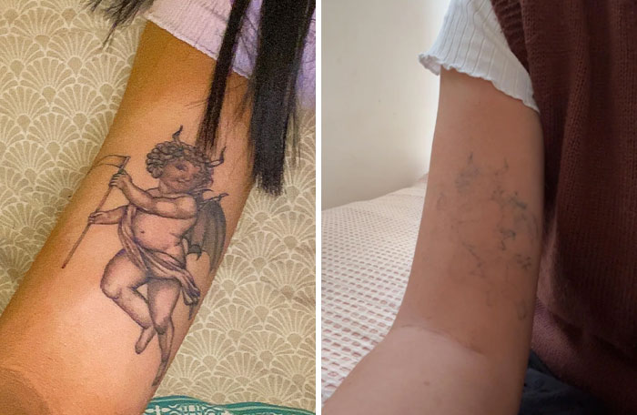 “Changed My Life!” 80 Photos Before And After Tattoo Removal