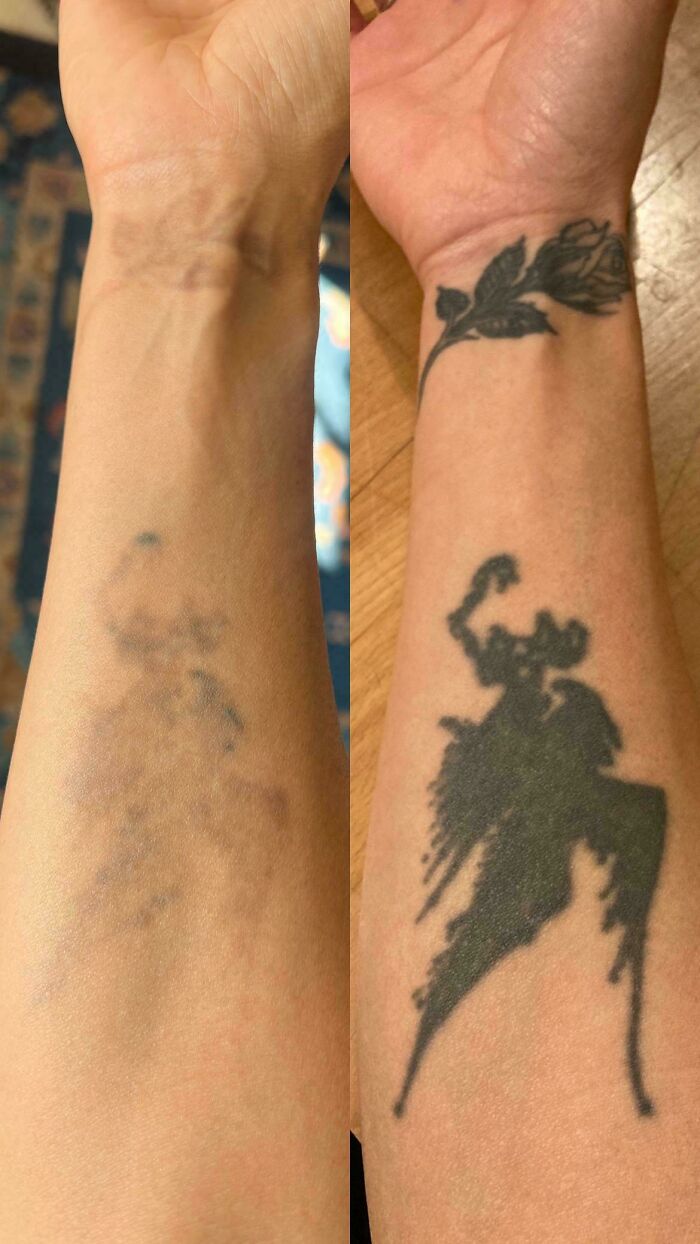 “Changed My Life!” 80 Photos Before And After Tattoo Removal
