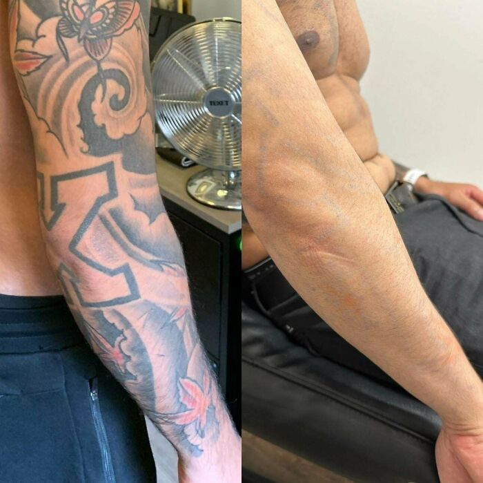 “Changed My Life!” 80 Photos Before And After Tattoo Removal