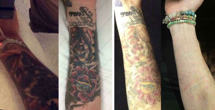 “Changed My Life!” 80 Photos Before And After Tattoo Removal