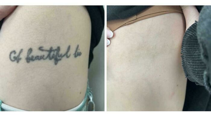“Changed My Life!” 80 Photos Before And After Tattoo Removal