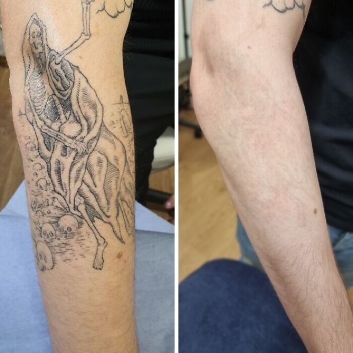 “Changed My Life!” 80 Photos Before And After Tattoo Removal