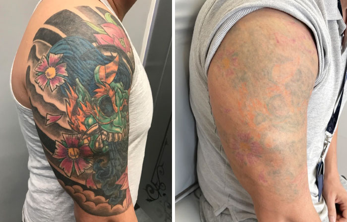 “Changed My Life!” 80 Photos Before And After Tattoo Removal
