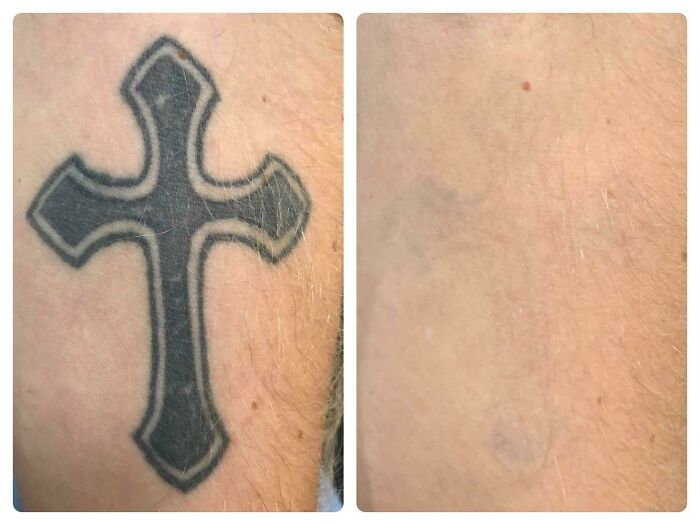“Changed My Life!” 80 Photos Before And After Tattoo Removal