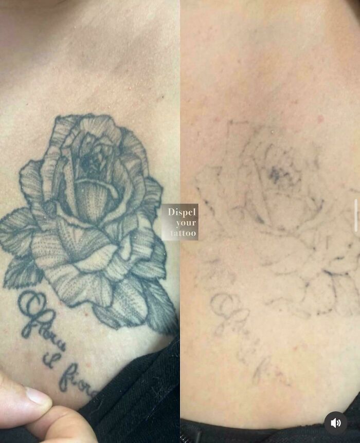 “Changed My Life!” 80 Photos Before And After Tattoo Removal