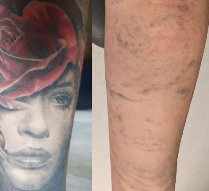“Changed My Life!” 80 Photos Before And After Tattoo Removal