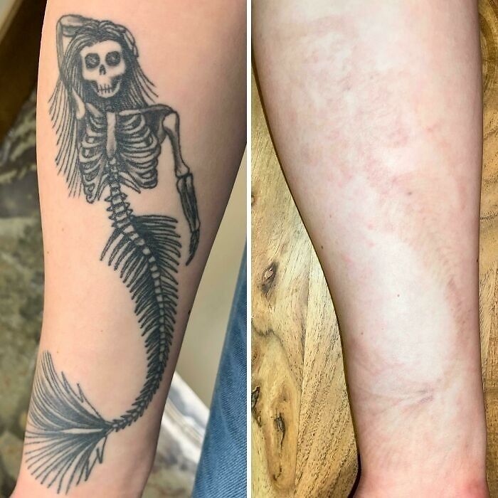 “Changed My Life!” 80 Photos Before And After Tattoo Removal