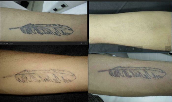 “Changed My Life!” 80 Photos Before And After Tattoo Removal