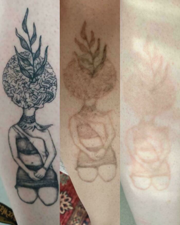 “Changed My Life!” 80 Photos Before And After Tattoo Removal