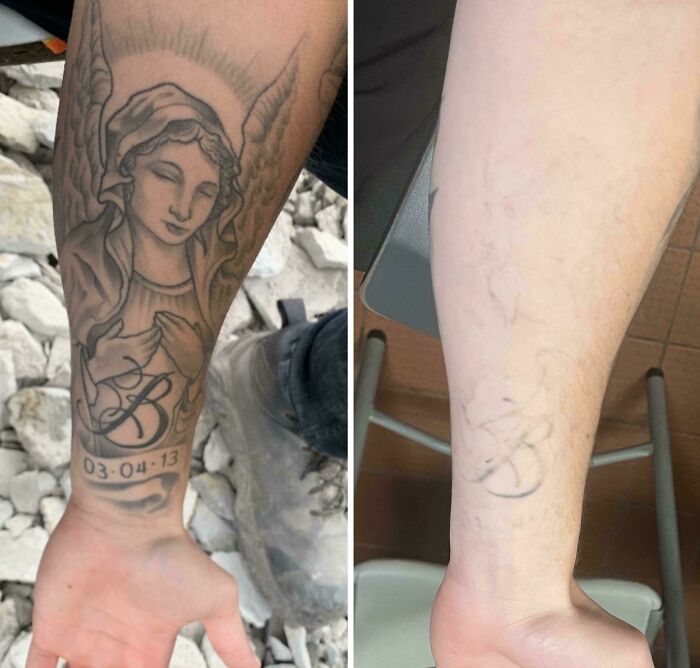 “Changed My Life!” 80 Photos Before And After Tattoo Removal