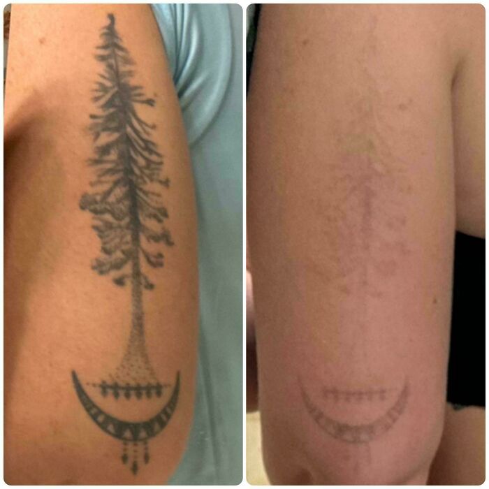 “Changed My Life!” 80 Photos Before And After Tattoo Removal