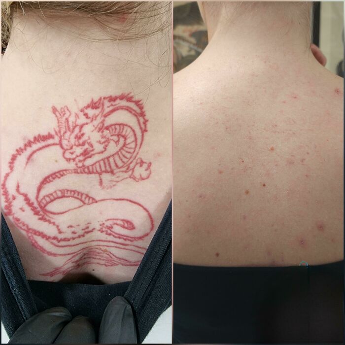 “Changed My Life!” 80 Photos Before And After Tattoo Removal