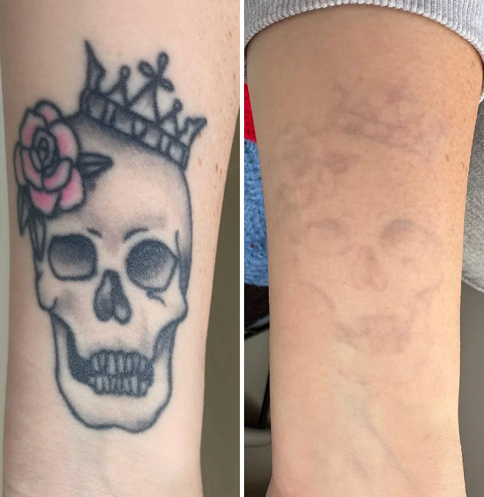 “Changed My Life!” 80 Photos Before And After Tattoo Removal