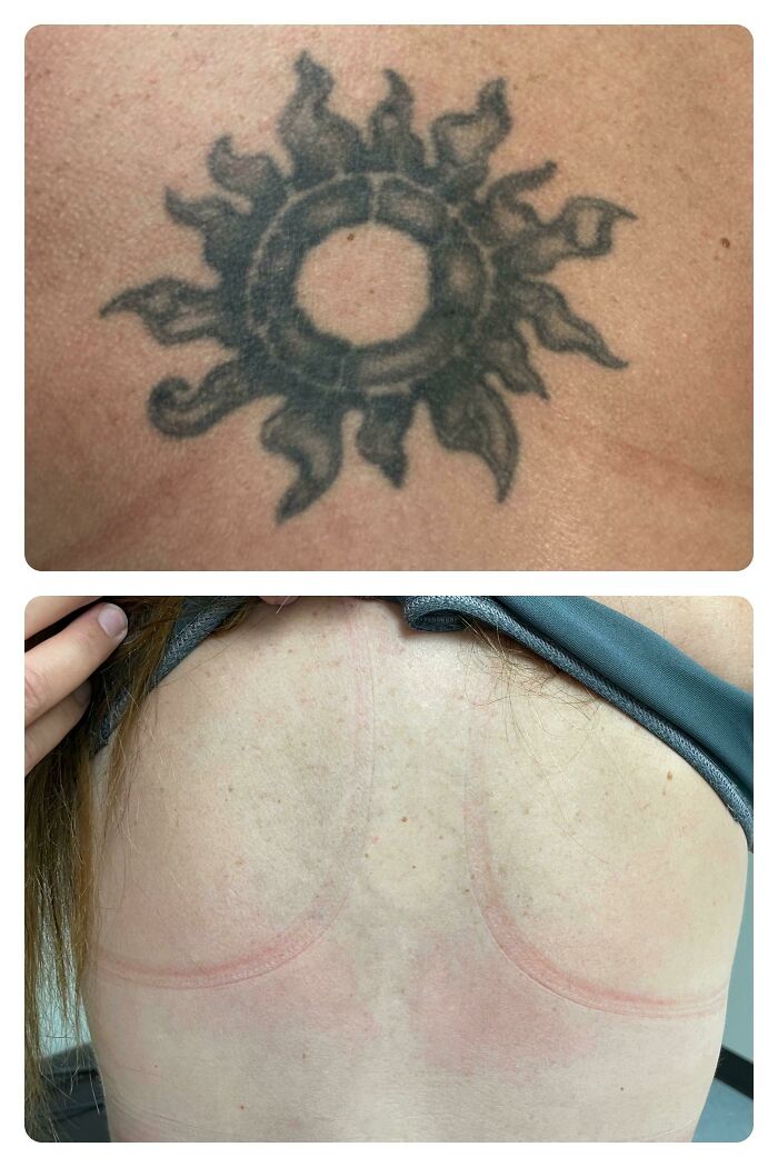 “Changed My Life!” 80 Photos Before And After Tattoo Removal