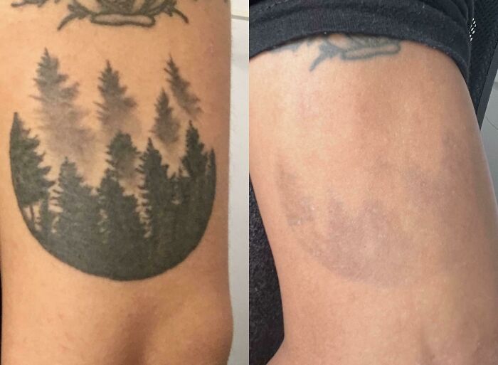 “Changed My Life!” 80 Photos Before And After Tattoo Removal
