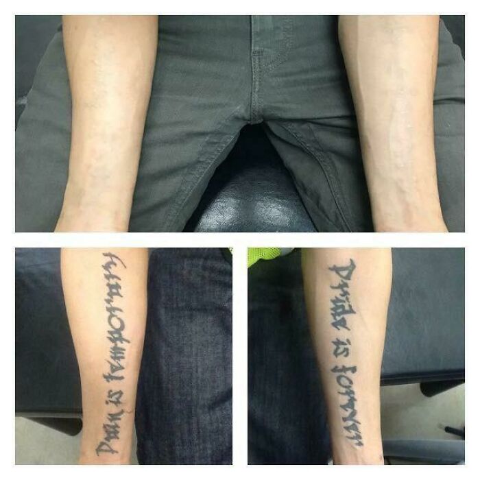 “Changed My Life!” 80 Photos Before And After Tattoo Removal