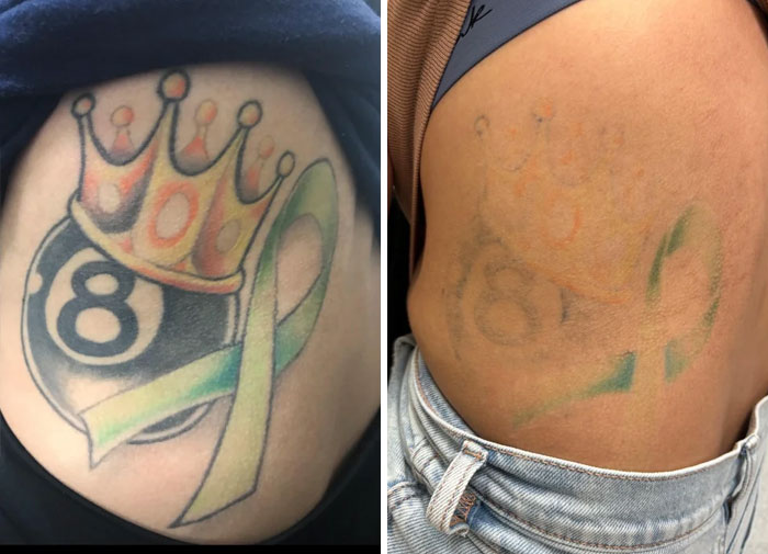 “Changed My Life!” 80 Photos Before And After Tattoo Removal