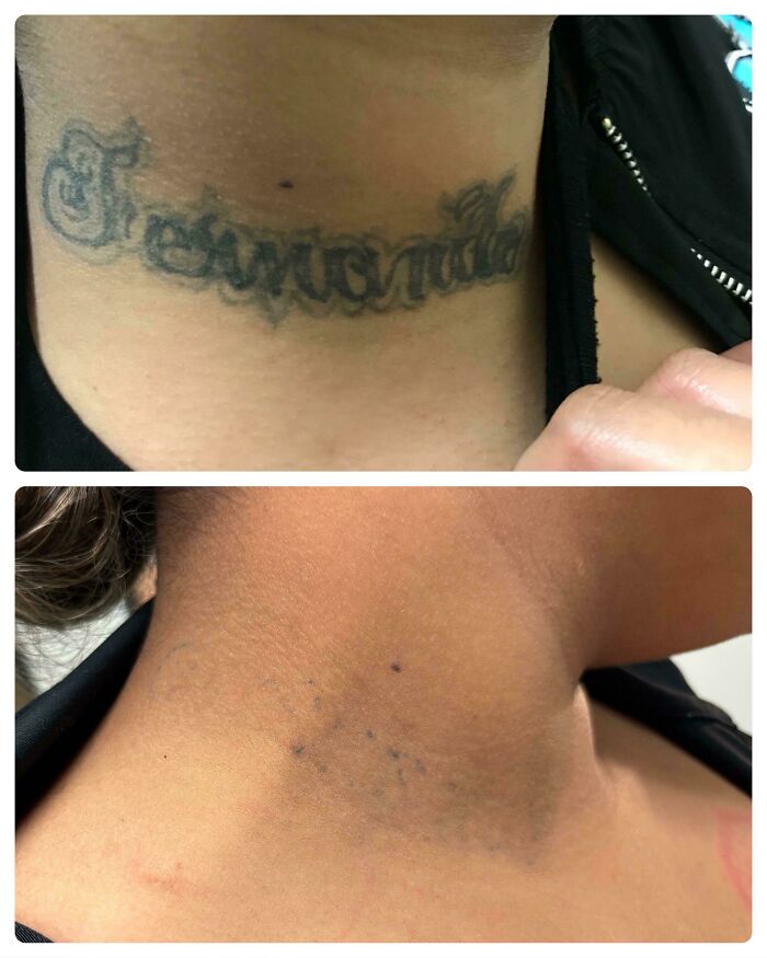 “Changed My Life!” 80 Photos Before And After Tattoo Removal