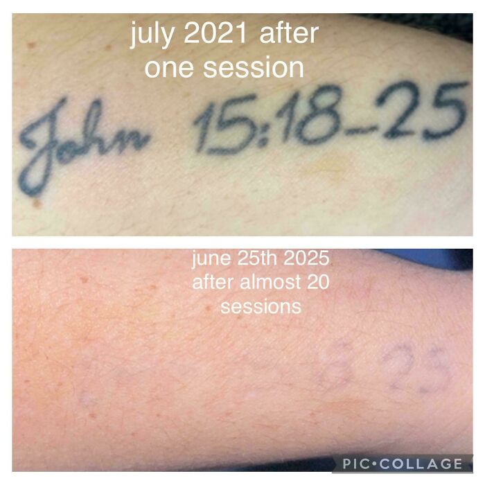 “Changed My Life!” 80 Photos Before And After Tattoo Removal