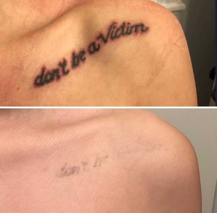 “Changed My Life!” 80 Photos Before And After Tattoo Removal