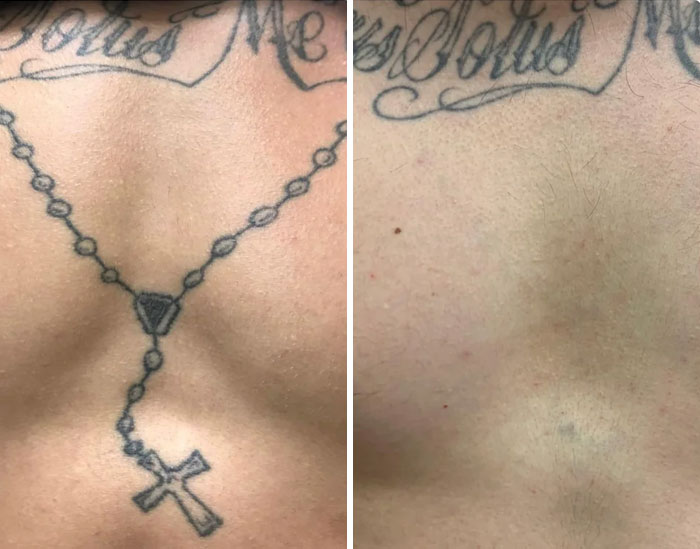 “Changed My Life!” 80 Photos Before And After Tattoo Removal
