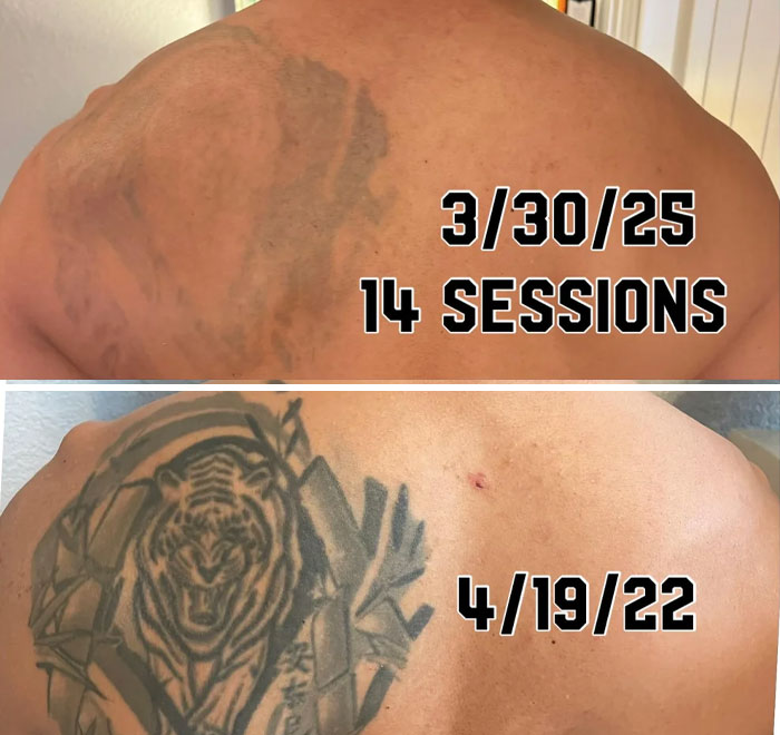 “Changed My Life!” 80 Photos Before And After Tattoo Removal