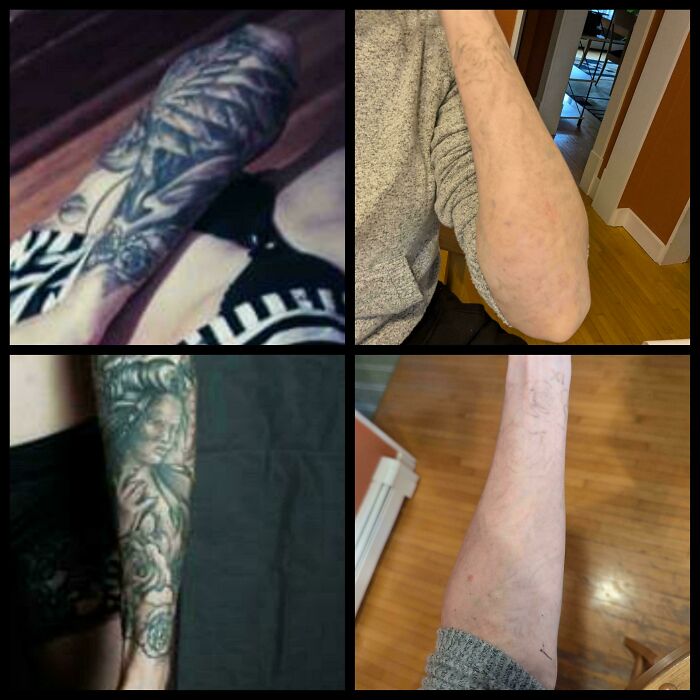 “Changed My Life!” 80 Photos Before And After Tattoo Removal