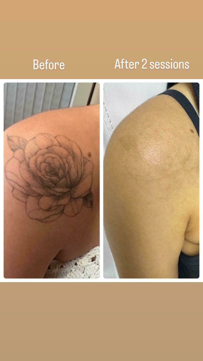 “Changed My Life!” 80 Photos Before And After Tattoo Removal