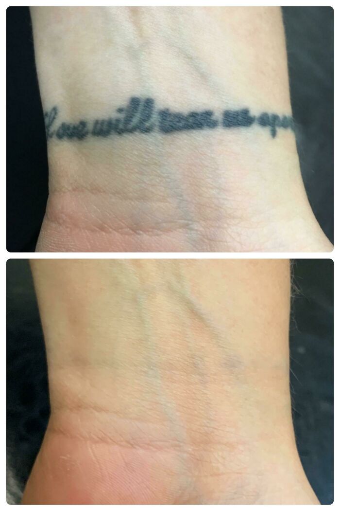 “Changed My Life!” 80 Photos Before And After Tattoo Removal