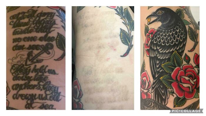 “Changed My Life!” 80 Photos Before And After Tattoo Removal