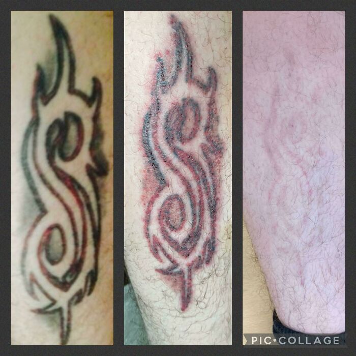“Changed My Life!” 80 Photos Before And After Tattoo Removal
