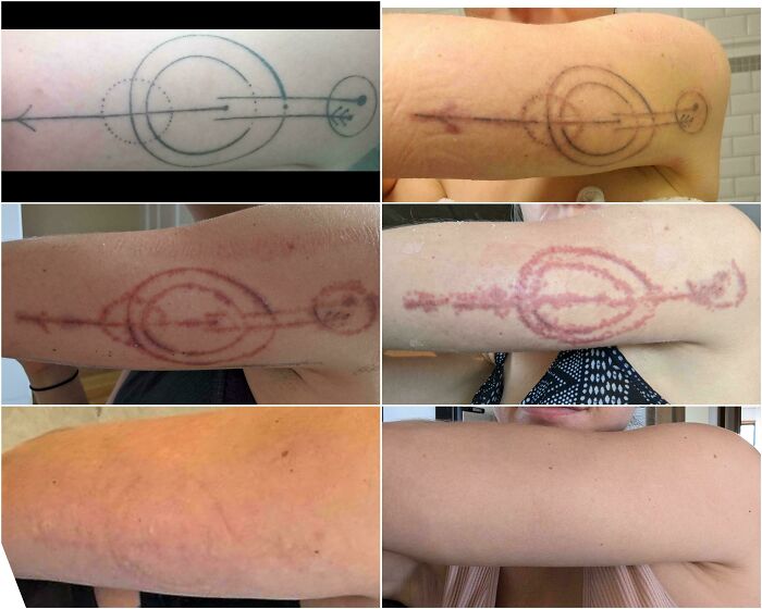 “Changed My Life!” 80 Photos Before And After Tattoo Removal