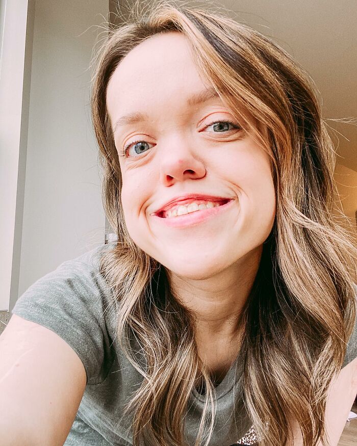 31YO Woman With Dwarfism Who Had Height Surgery As A Teen Stuns Fans With Transformation