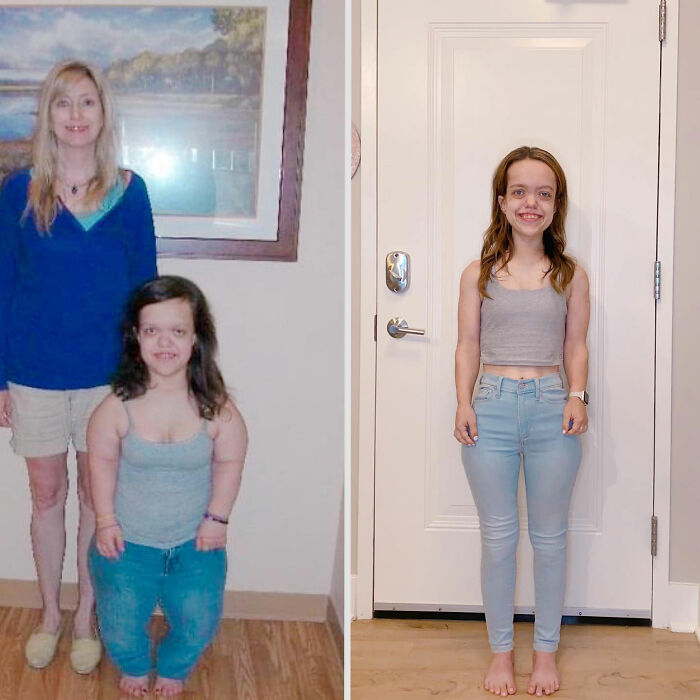 31YO Woman With Dwarfism Who Had Height Surgery As A Teen Stuns Fans With Transformation