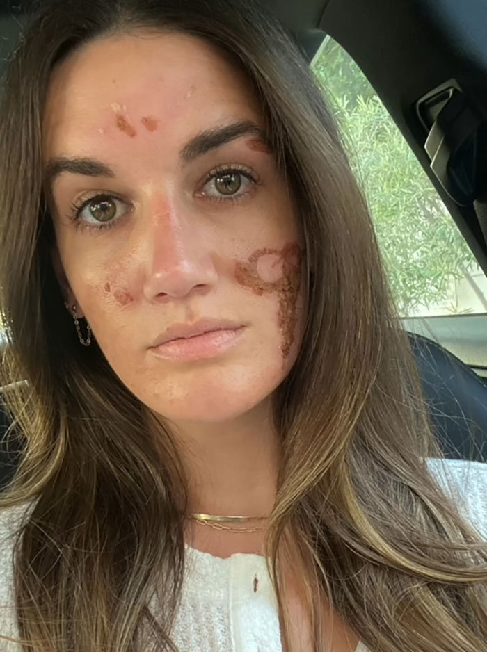 &#8220;She Ruined Me&#8221;: Woman Claims $90,000 Repairs After Celebrity Facialist “Permanently Disfigured” Her
