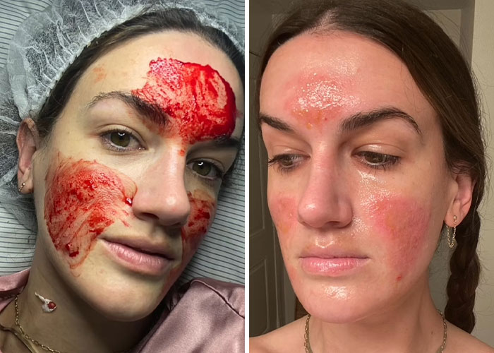 &#8220;She Ruined Me&#8221;: Woman Claims $90,000 Repairs After Celebrity Facialist “Permanently Disfigured” Her