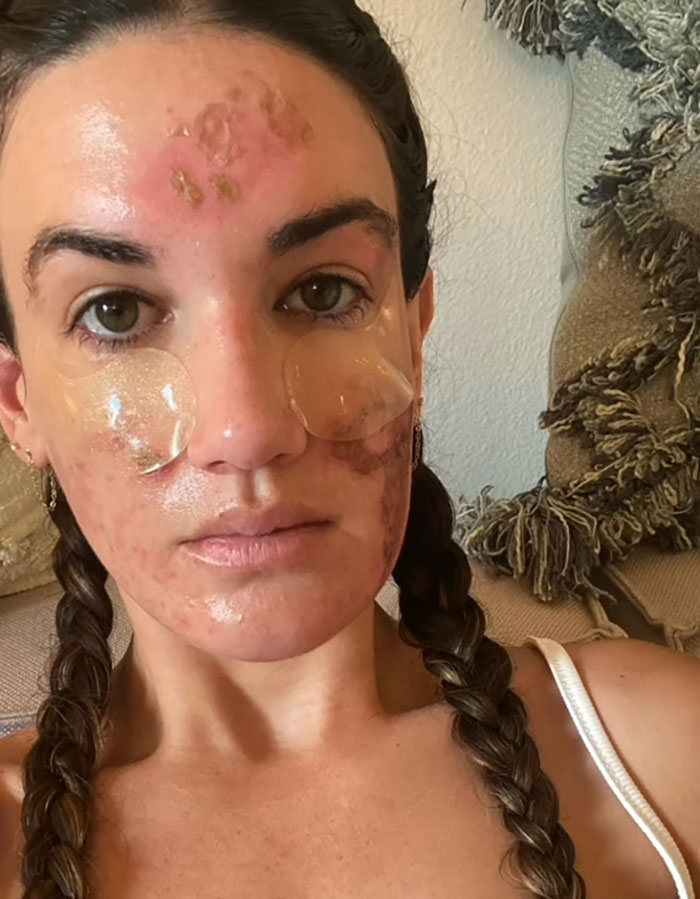 &#8220;She Ruined Me&#8221;: Woman Claims $90,000 Repairs After Celebrity Facialist “Permanently Disfigured” Her
