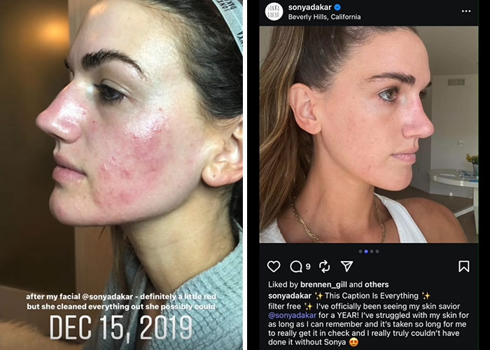 &#8220;She Ruined Me&#8221;: Woman Claims $90,000 Repairs After Celebrity Facialist “Permanently Disfigured” Her