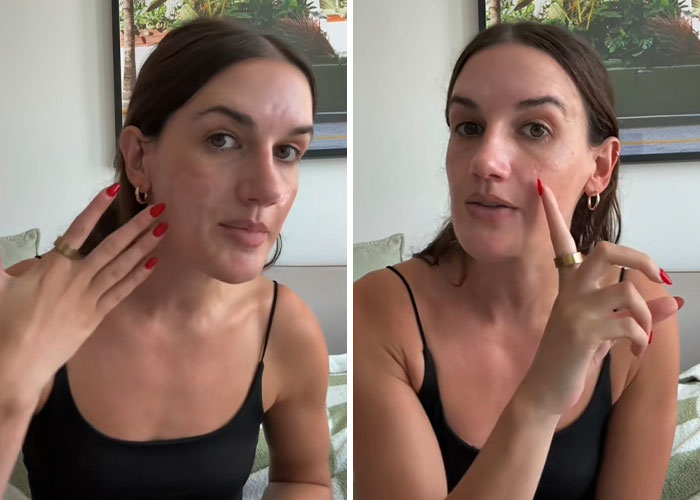 &#8220;She Ruined Me&#8221;: Woman Claims $90,000 Repairs After Celebrity Facialist “Permanently Disfigured” Her
