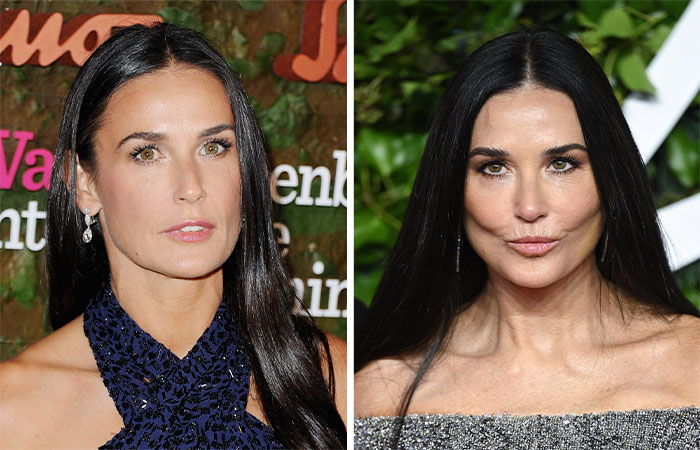 29 Celebrities Fans Believe Ruined Their Beauty With Buccal Fat Removal
