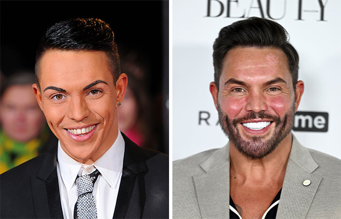 29 Celebrities Fans Believe Ruined Their Beauty With Buccal Fat Removal