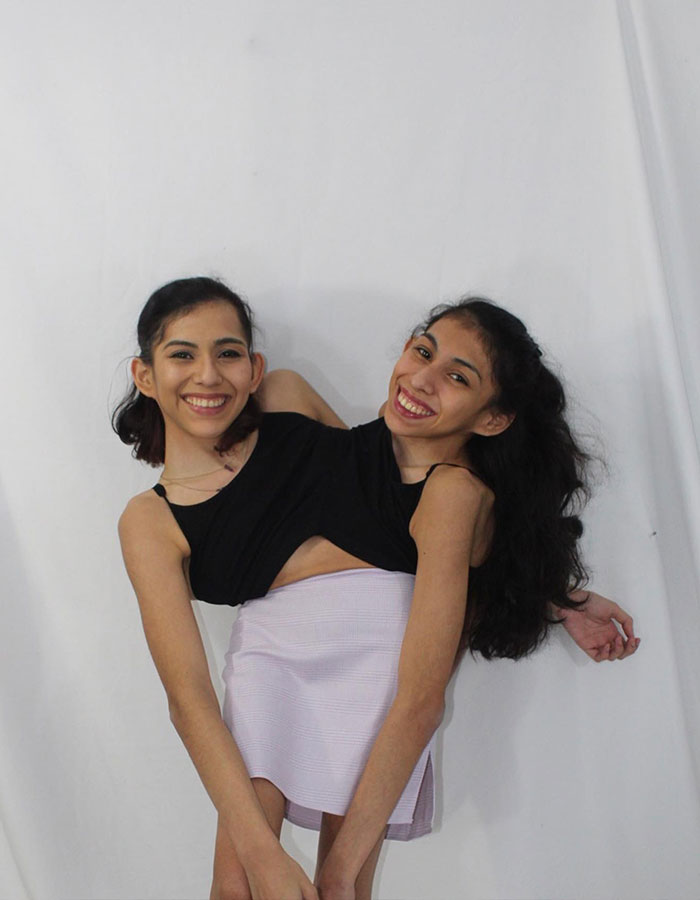 Conjoined Twin Carmen Andrade Hits Back at Backlash Over Her Intimate Life With Husband