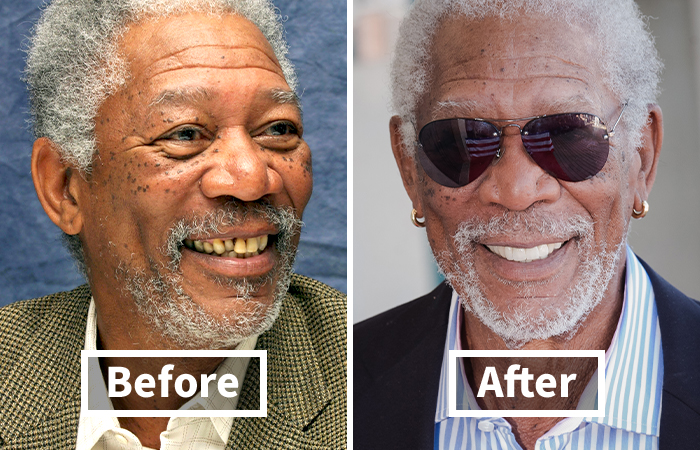 Veneers Before And After: Photos Of 15 Celebrities With The Most Dramatic Smile Makeover